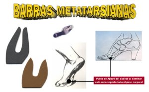 Las barras metatarsianas te ayudarán a evitar el dolor en los metatarsos